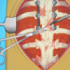 Scoliosis Surgery Image