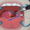 Tonsil Surgery Image