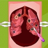 Mori's Lung Surgery